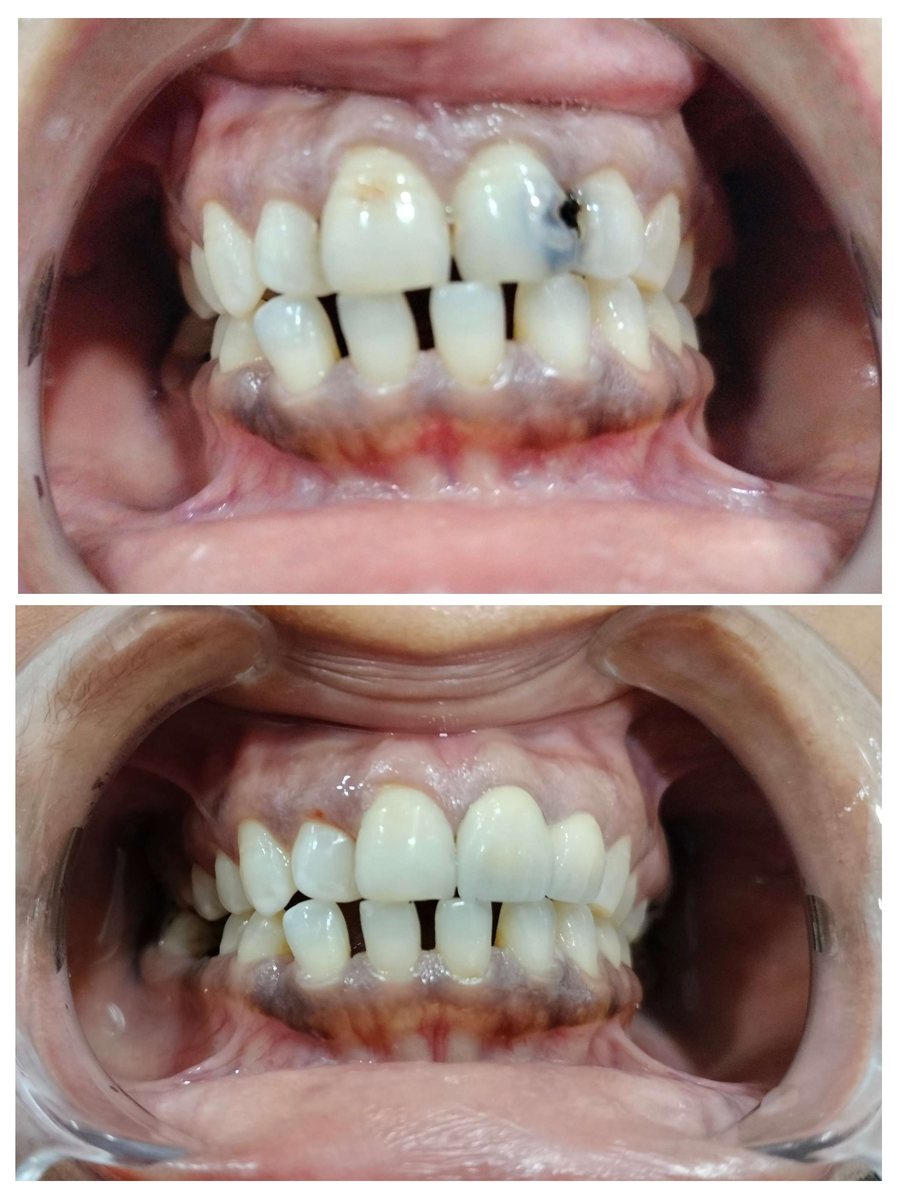 Before and after crown restoration