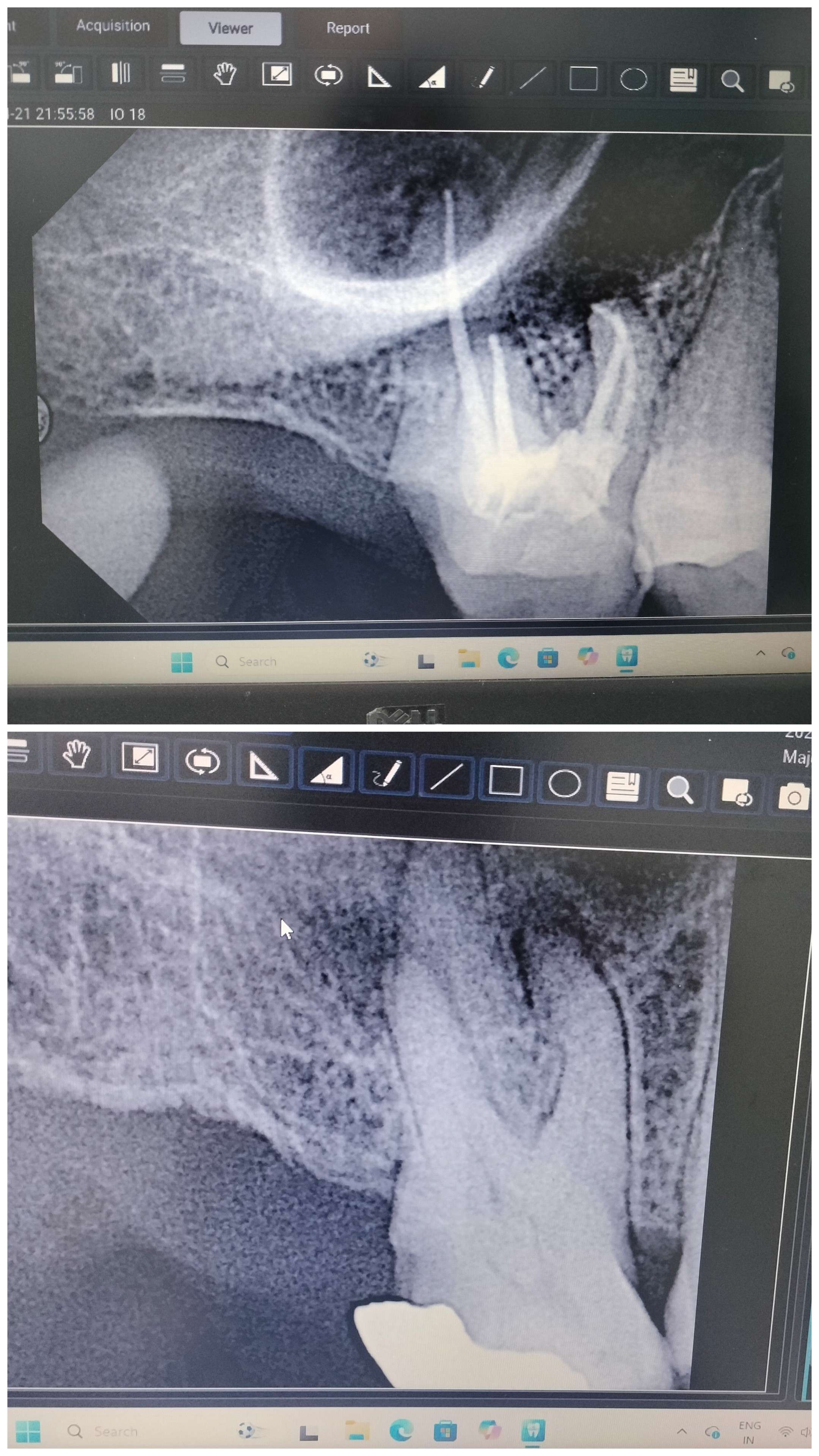 Completed root canal X-ray