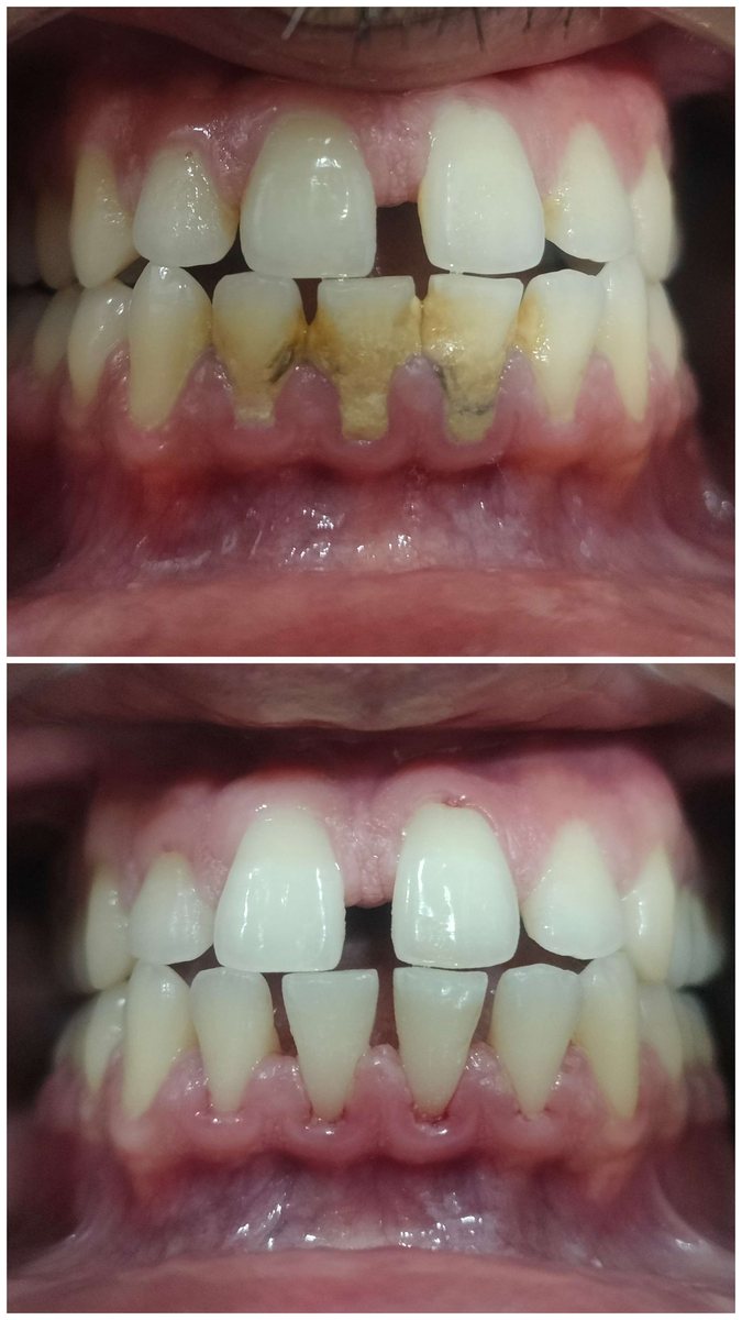 Deep scaling and stain removal